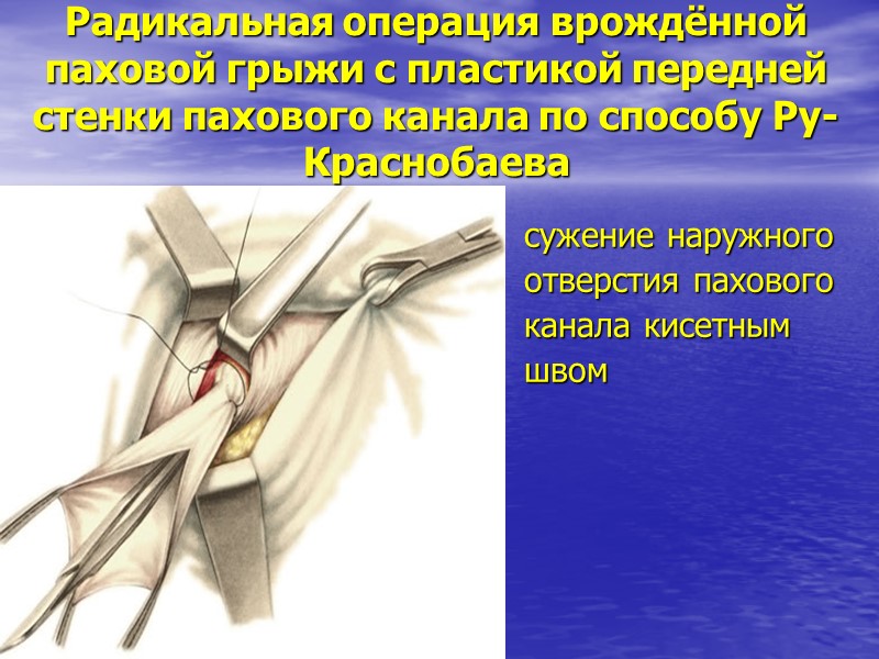Радикальная операция врождённой паховой грыжи с пластикой передней стенки пахового канала по способу Ру-Краснобаева